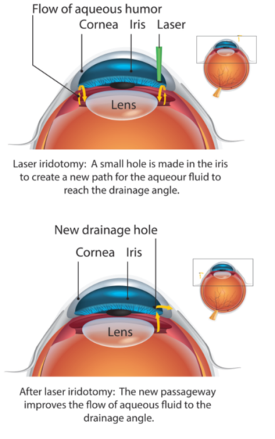 Illustration of Laser Iridotomy procedure 