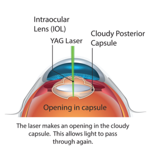 YAG Capsulotomy Laser Illustration