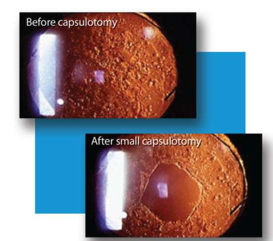 Before and after scans from YAG Capsulotomy Laser procedure for cataract treatment